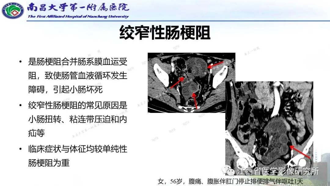 影像PPT - 【PPT】消化道急腹症的CT诊断-18