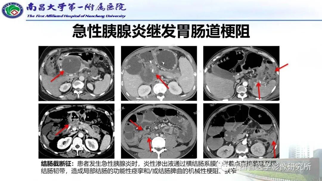 影像PPT - 【PPT】消化道急腹症的CT诊断-19
