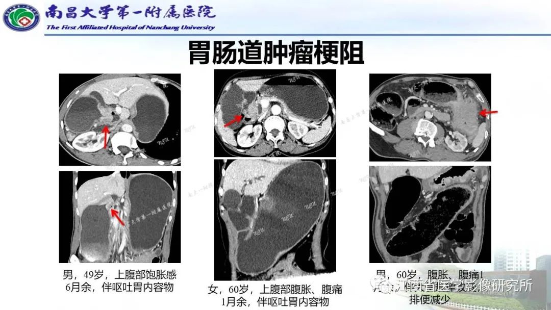 影像PPT - 【PPT】消化道急腹症的CT诊断-20