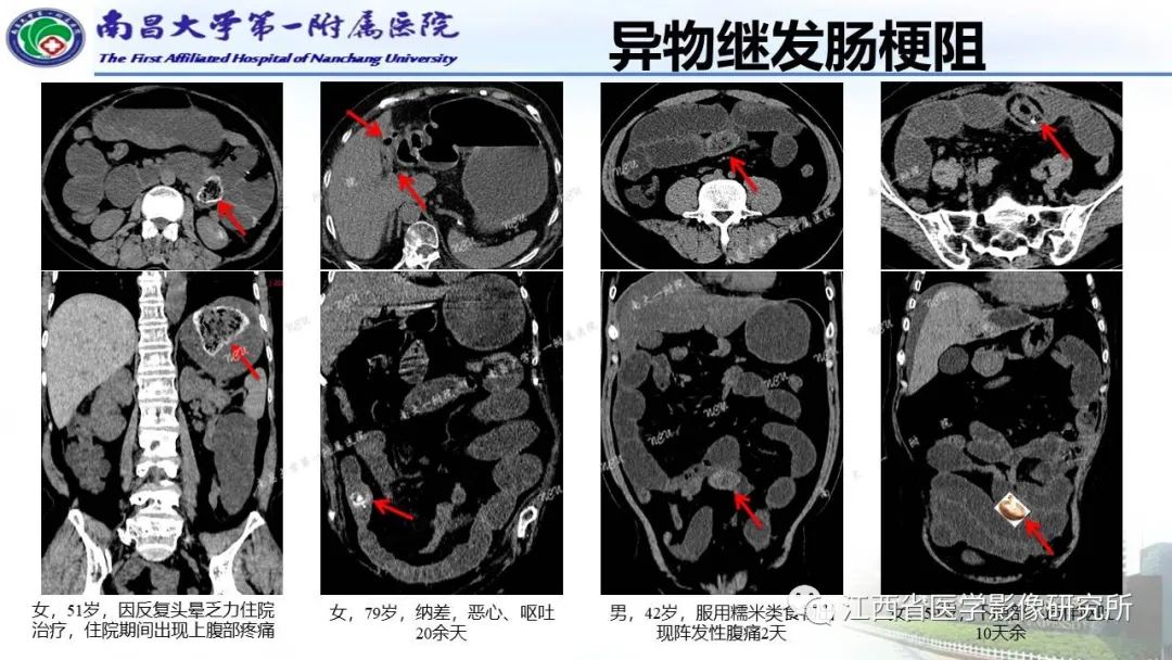 影像PPT - 【PPT】消化道急腹症的CT诊断-21