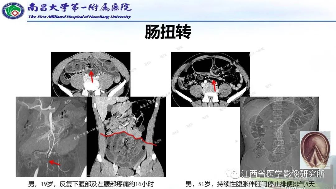 影像PPT - 【PPT】消化道急腹症的CT诊断-23