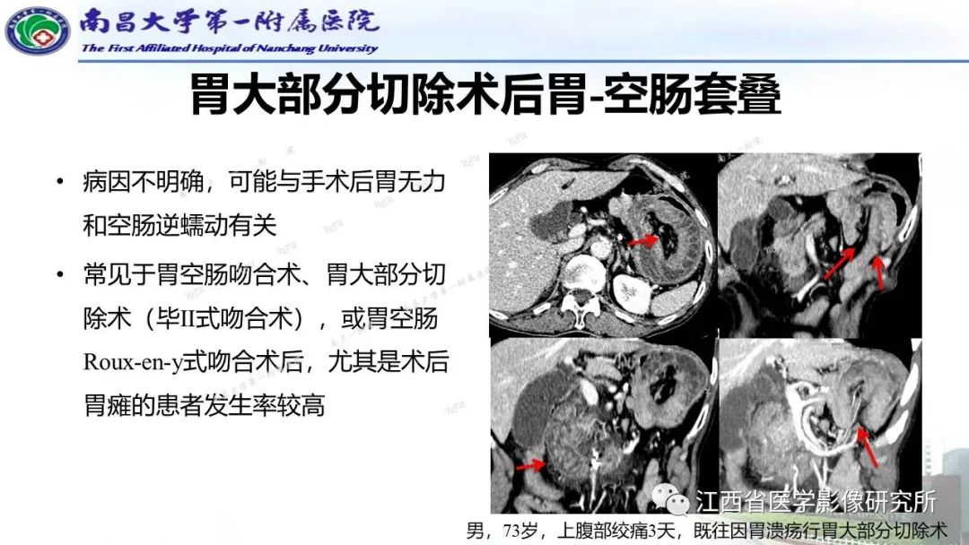 影像PPT - 【PPT】消化道急腹症的CT诊断-24