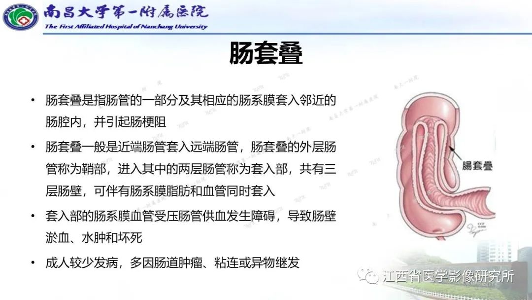 影像PPT - 【PPT】消化道急腹症的CT诊断-25