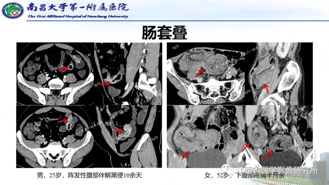 影像PPT - 【PPT】消化道急腹症的CT诊断-26