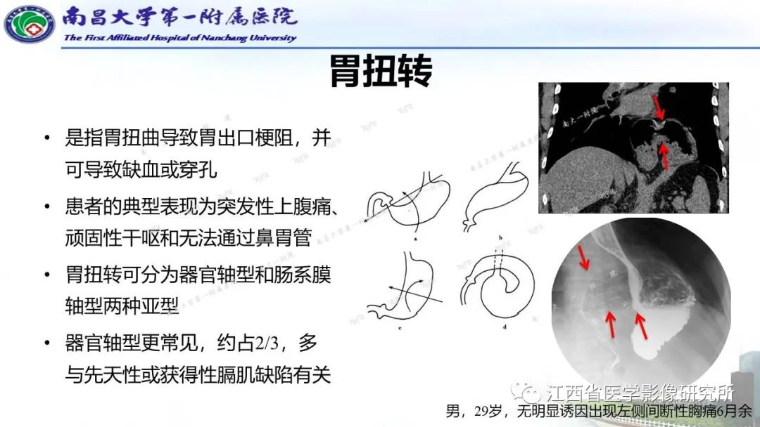 影像PPT - 【PPT】消化道急腹症的CT诊断-22
