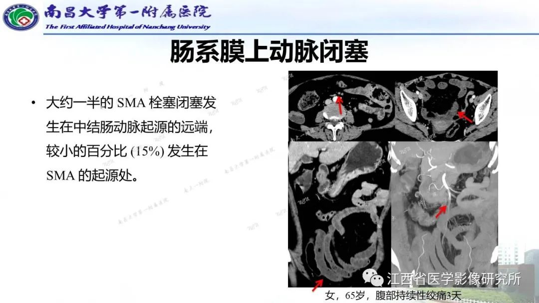 影像PPT - 【PPT】消化道急腹症的CT诊断-28