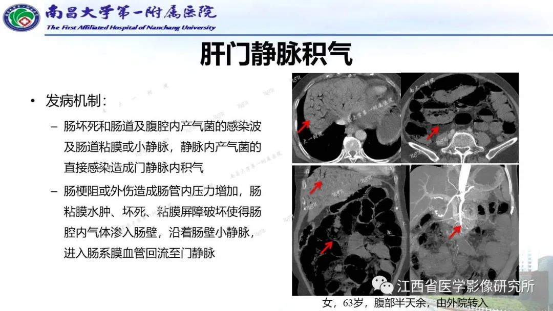 影像PPT - 【PPT】消化道急腹症的CT诊断-29