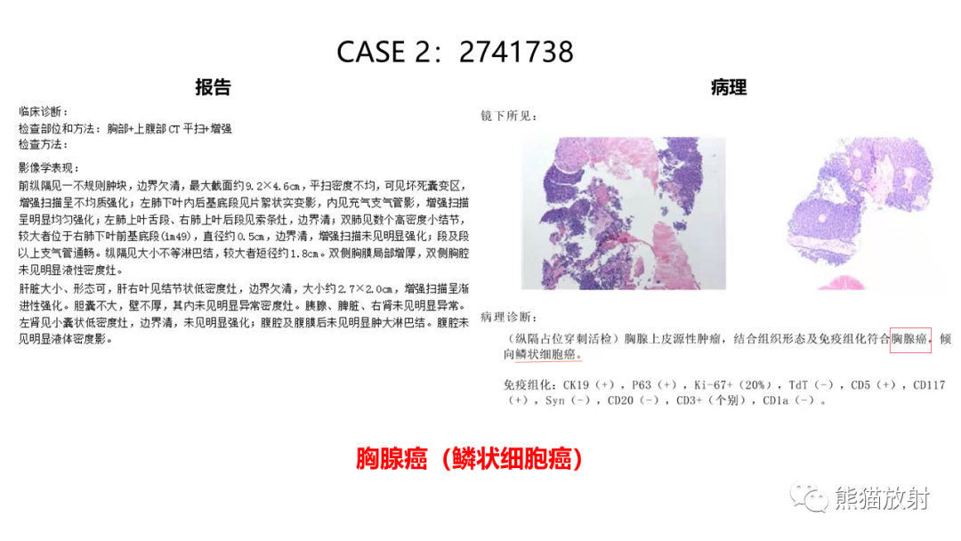 影像PPT - 【病例】纵隔神经内分泌癌 VS 胸腺鳞癌-22