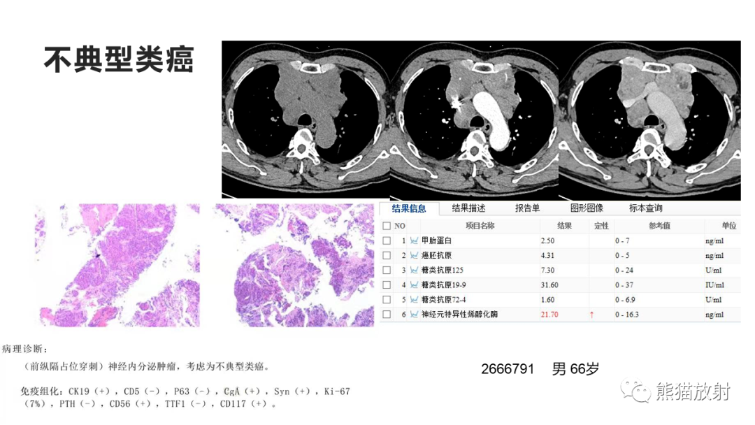 影像PPT - 【病例】纵隔神经内分泌癌 VS 胸腺鳞癌-30