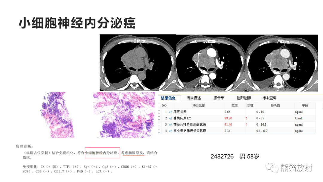 影像PPT - 【病例】纵隔神经内分泌癌 VS 胸腺鳞癌-34