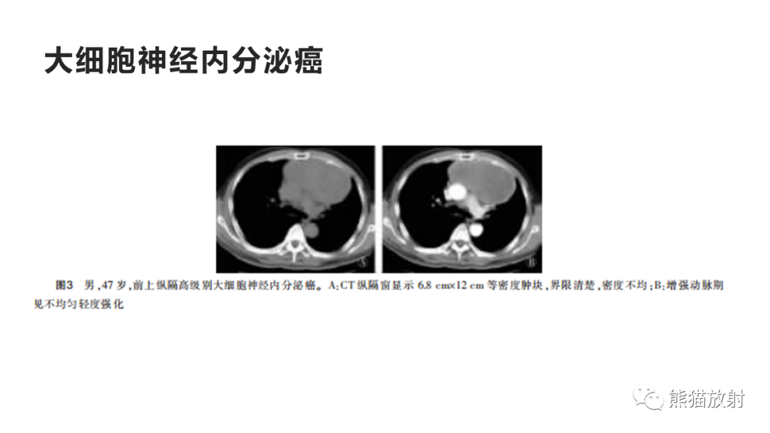 影像PPT - 【病例】纵隔神经内分泌癌 VS 胸腺鳞癌-35