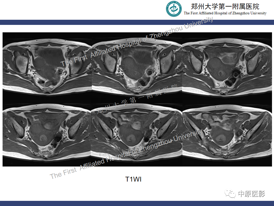影像PPT - 【病例】富细胞型子宫肌瘤1例MR影像-3