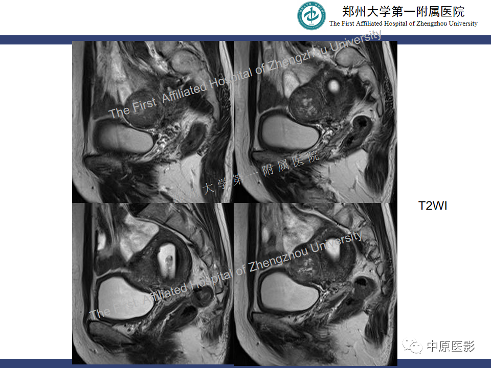 影像PPT - 【病例】富细胞型子宫肌瘤1例MR影像-4