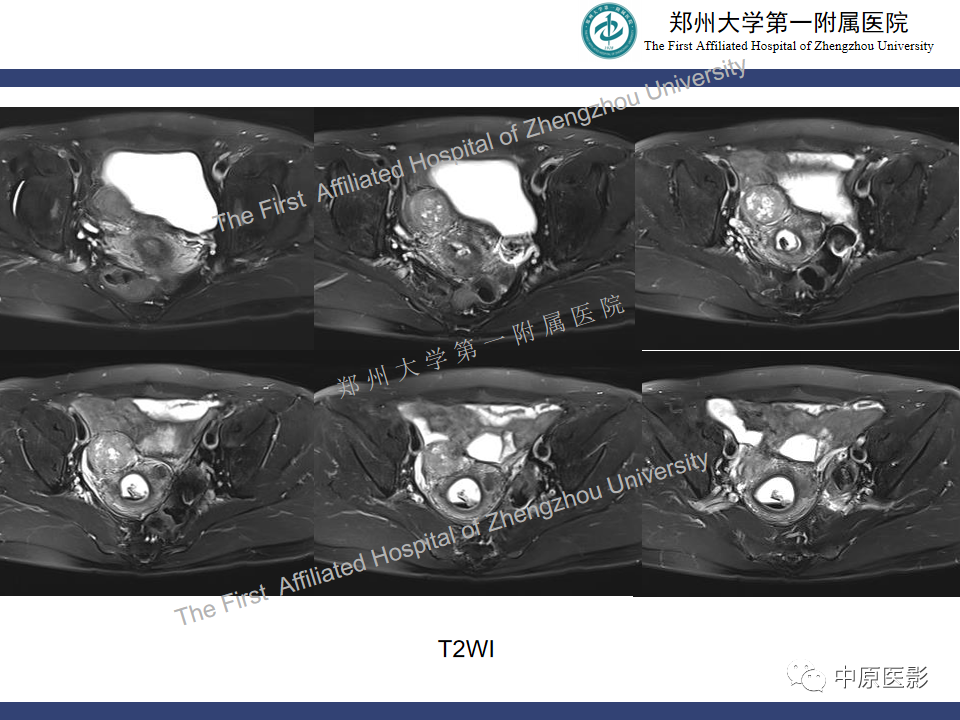 影像PPT - 【病例】富细胞型子宫肌瘤1例MR影像-5