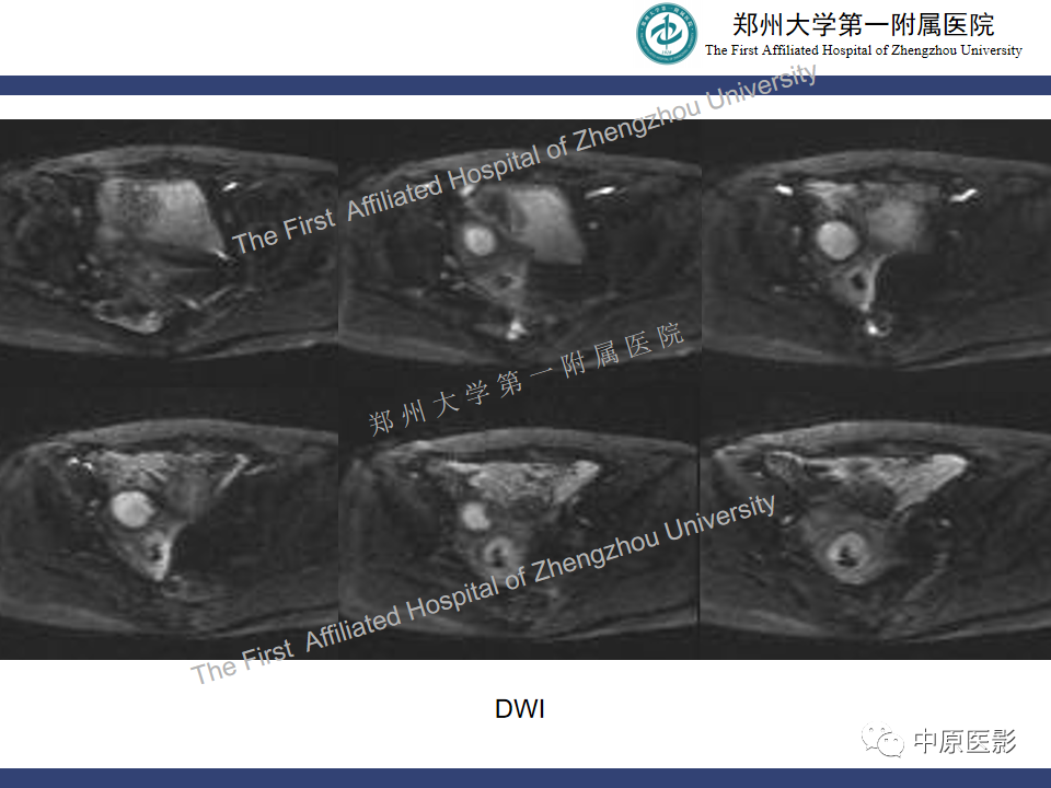 影像PPT - 【病例】富细胞型子宫肌瘤1例MR影像-6