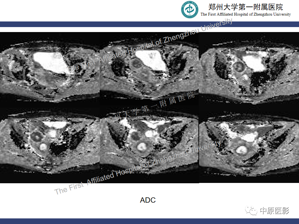 影像PPT - 【病例】富细胞型子宫肌瘤1例MR影像-7