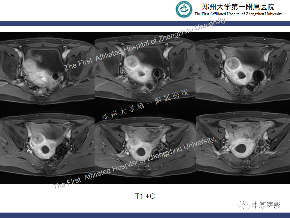 影像PPT - 【病例】富细胞型子宫肌瘤1例MR影像-9