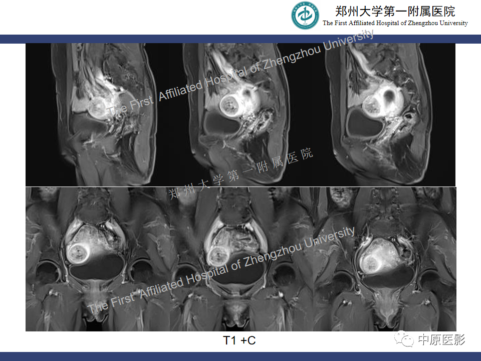影像PPT - 【病例】富细胞型子宫肌瘤1例MR影像-10