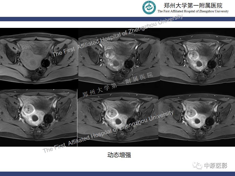 影像PPT - 【病例】富细胞型子宫肌瘤1例MR影像-8
