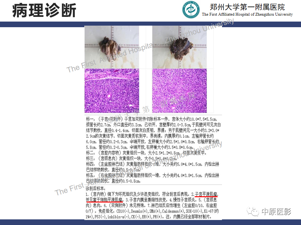 影像PPT - 【病例】富细胞型子宫肌瘤1例MR影像-13