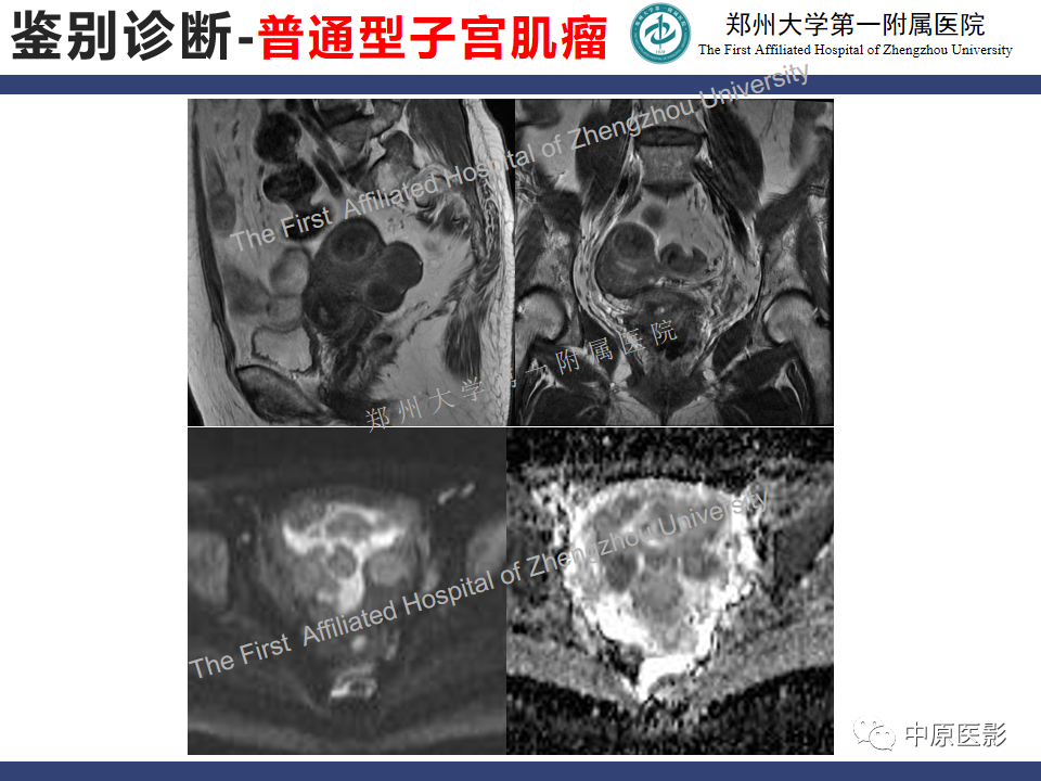 影像PPT - 【病例】富细胞型子宫肌瘤1例MR影像-17