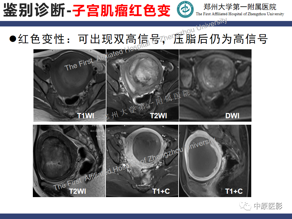 影像PPT - 【病例】富细胞型子宫肌瘤1例MR影像-20