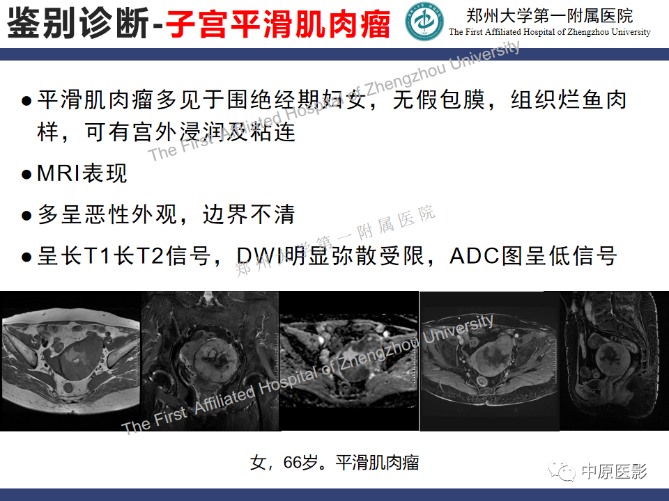 影像PPT - 【病例】富细胞型子宫肌瘤1例MR影像-22