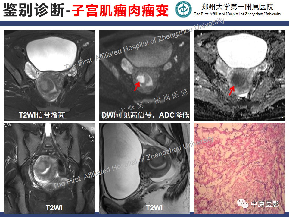 影像PPT - 【病例】富细胞型子宫肌瘤1例MR影像-21