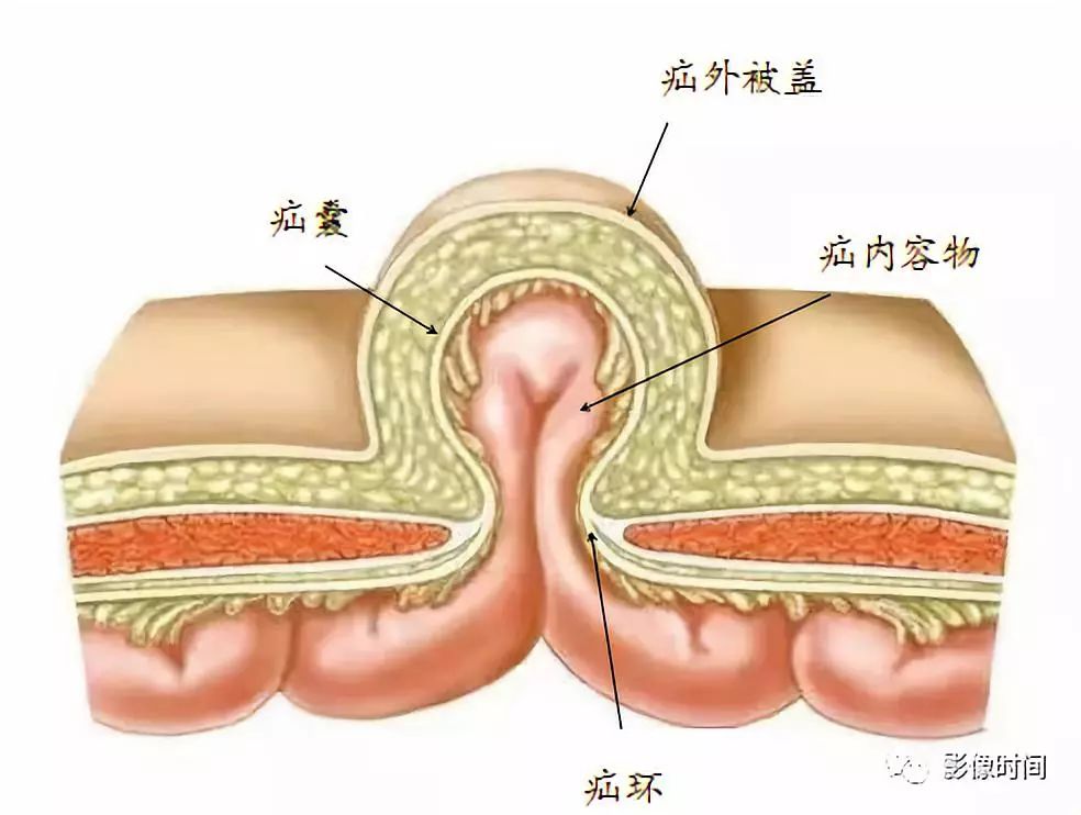 影像PPT - 腹外疝的影像表现-1 影像PPT - 腹外疝的影像表现-1