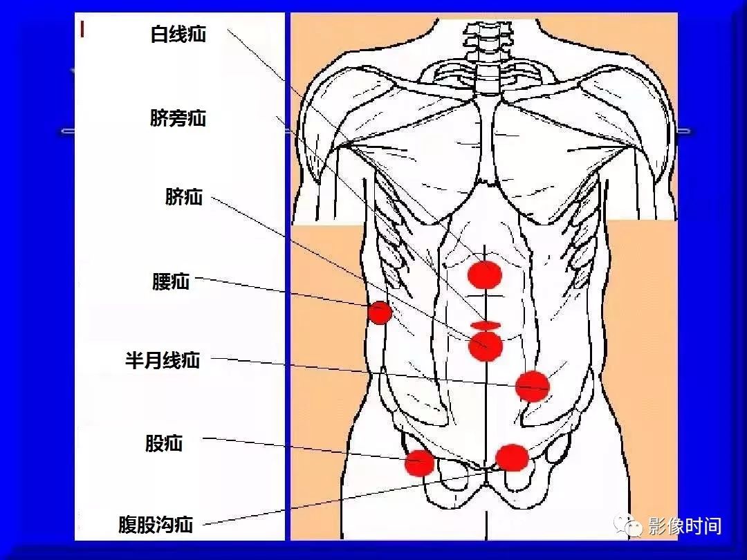 影像PPT - 腹外疝的影像表现-2 影像PPT - 腹外疝的影像表现-2