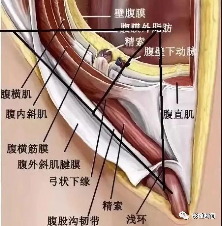 影像PPT - 腹外疝的影像表现-4 影像PPT - 腹外疝的影像表现-4