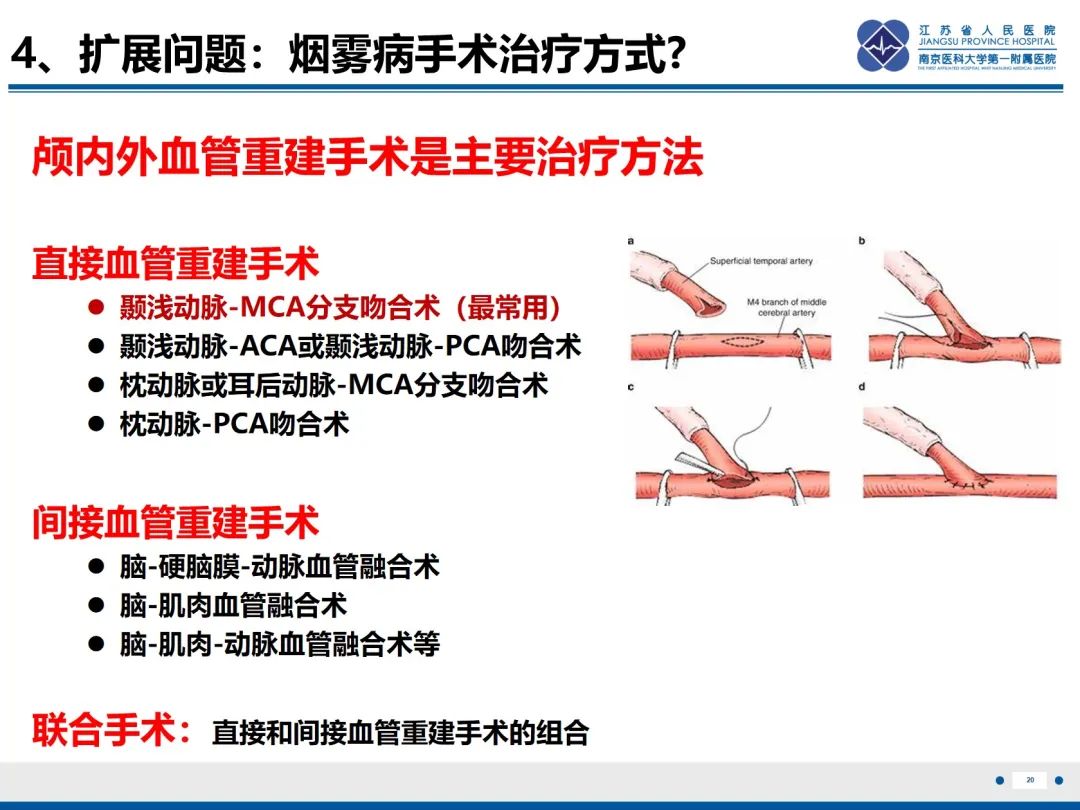 影像PPT - 【PPT】烟雾病和烟雾综合征血管重建术后影像评估-21