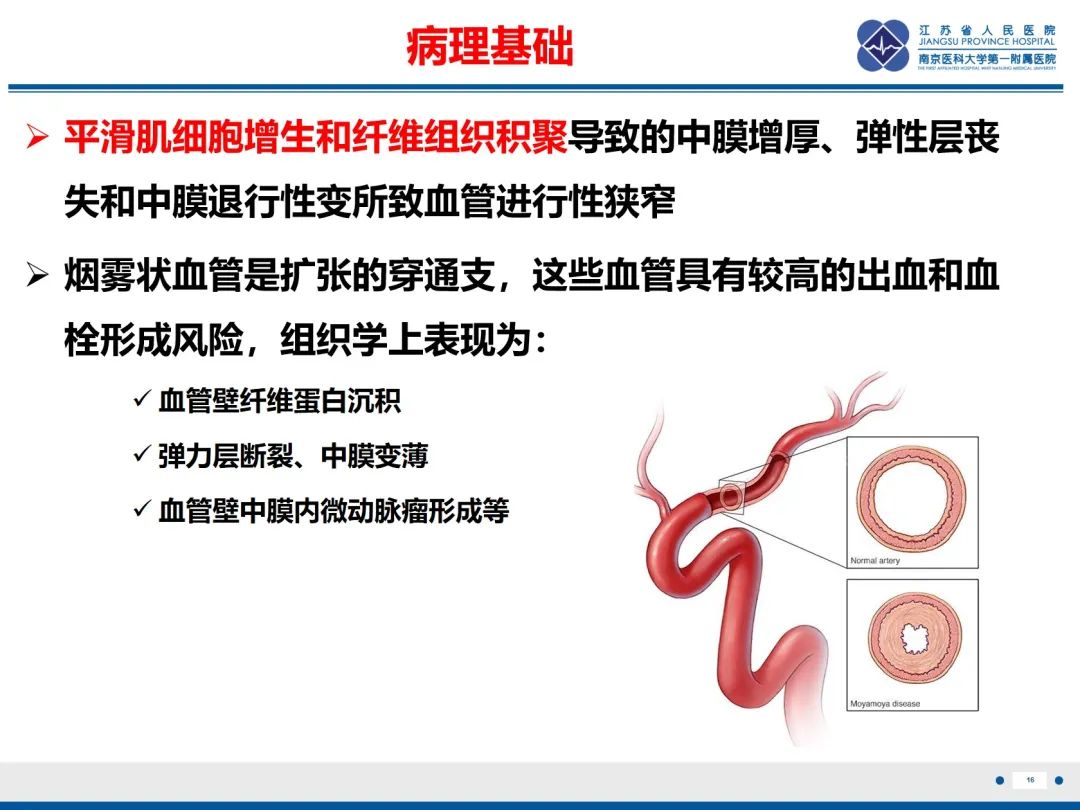 影像PPT - 【PPT】烟雾病和烟雾综合征血管重建术后影像评估-17