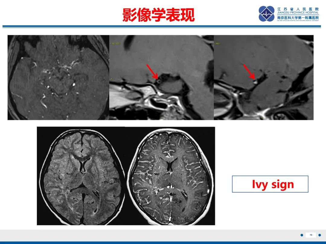 影像PPT - 【PPT】烟雾病和烟雾综合征血管重建术后影像评估-19