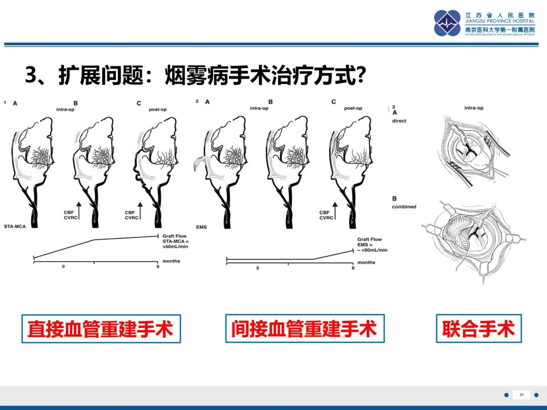 影像PPT - 【PPT】烟雾病和烟雾综合征血管重建术后影像评估-22