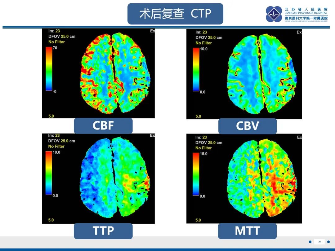 影像PPT - 【PPT】烟雾病和烟雾综合征血管重建术后影像评估-26