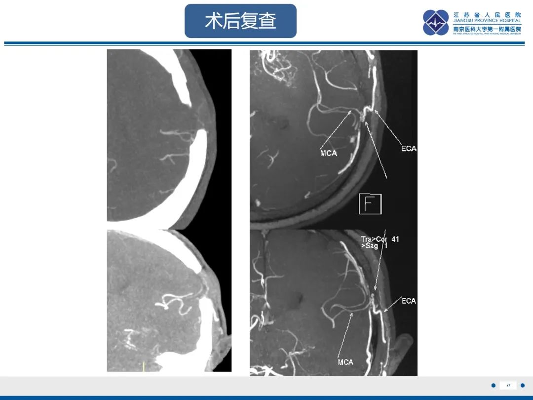 影像PPT - 【PPT】烟雾病和烟雾综合征血管重建术后影像评估-28