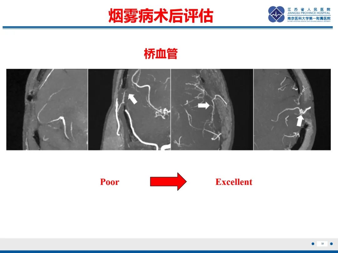 影像PPT - 【PPT】烟雾病和烟雾综合征血管重建术后影像评估-33