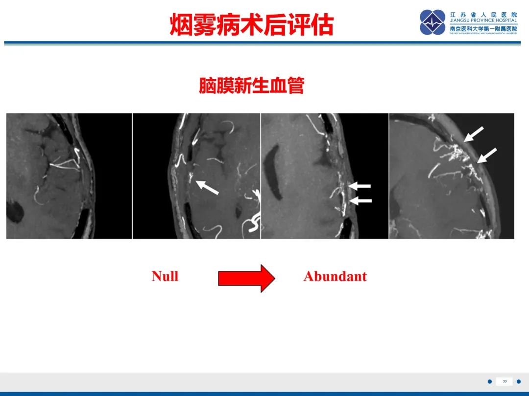 影像PPT - 【PPT】烟雾病和烟雾综合征血管重建术后影像评估-34
