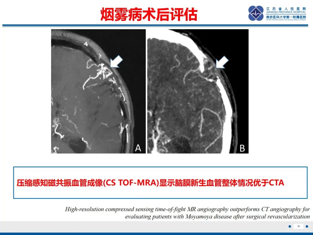影像PPT - 【PPT】烟雾病和烟雾综合征血管重建术后影像评估-36