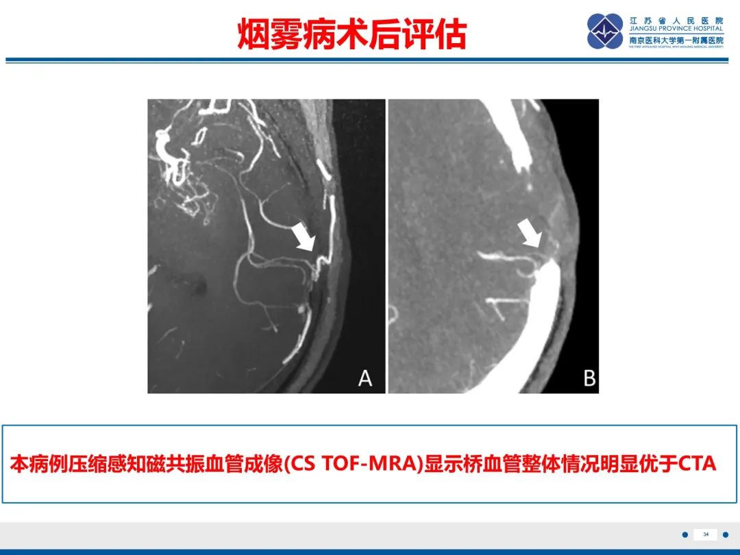 影像PPT - 【PPT】烟雾病和烟雾综合征血管重建术后影像评估-35