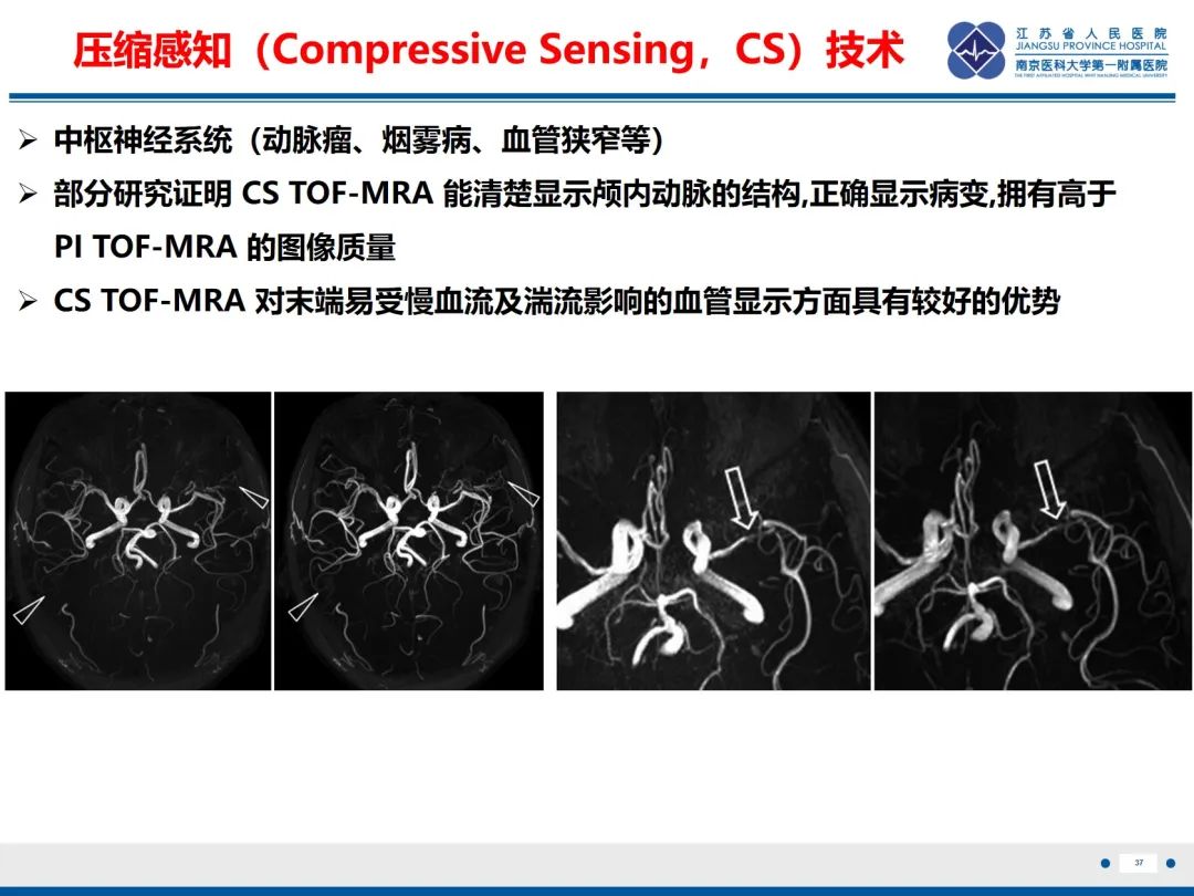 影像PPT - 【PPT】烟雾病和烟雾综合征血管重建术后影像评估-38