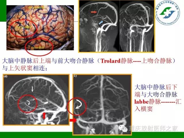 影像PPT - 【PPT】脑静脉解剖及相关疾病影像学诊断-8