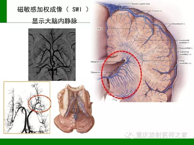 影像PPT - 【PPT】脑静脉解剖及相关疾病影像学诊断-10