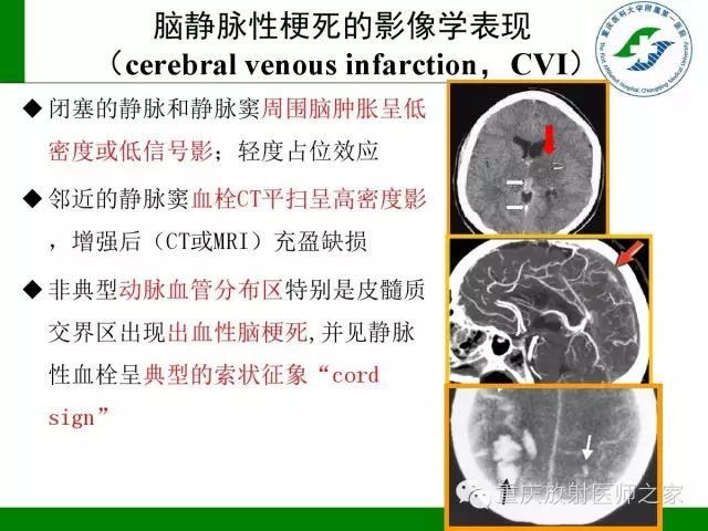 影像PPT - 【PPT】脑静脉解剖及相关疾病影像学诊断-20