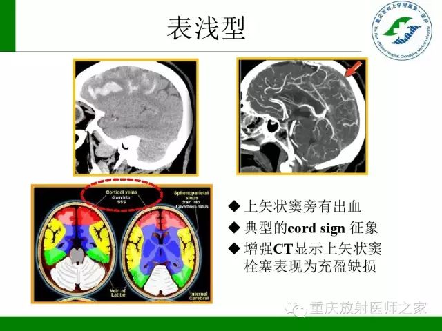 影像PPT - 【PPT】脑静脉解剖及相关疾病影像学诊断-23