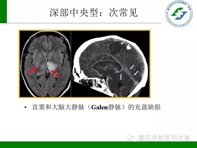 影像PPT - 【PPT】脑静脉解剖及相关疾病影像学诊断-25