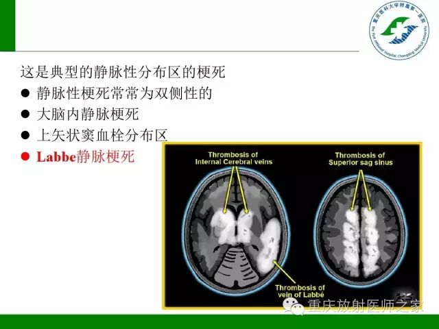 影像PPT - 【PPT】脑静脉解剖及相关疾病影像学诊断-21