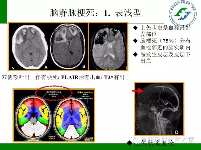 影像PPT - 【PPT】脑静脉解剖及相关疾病影像学诊断-22
