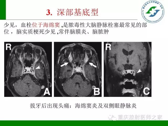 影像PPT - 【PPT】脑静脉解剖及相关疾病影像学诊断-26